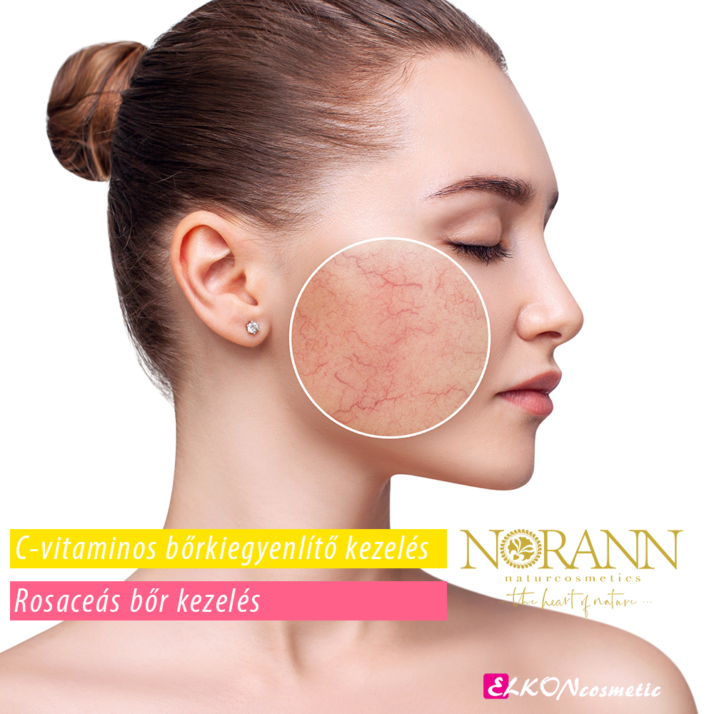 Rosaceas bőr kezelése / C vitaminos kezelések - Norann