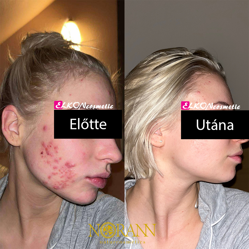 Norann aknés bőr kezelés előtt és után