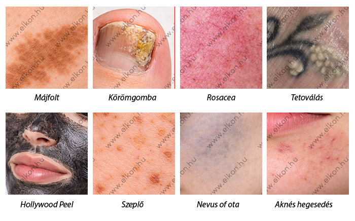 ND:YAG lézereses kezelések alkalmazási területei