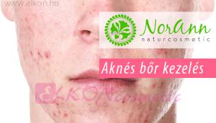 Aknés, problémás bőr, tini kezelések és utókezelések képzés - NorAnn